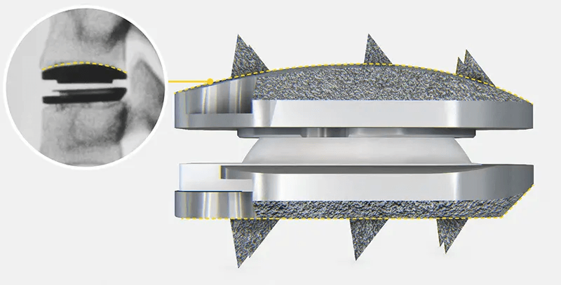 Centinel Spine Prodisc C VIVO