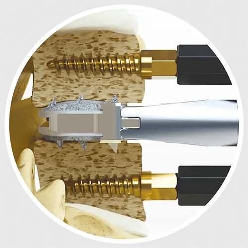 Centinel Spine Prodisc C VIVO